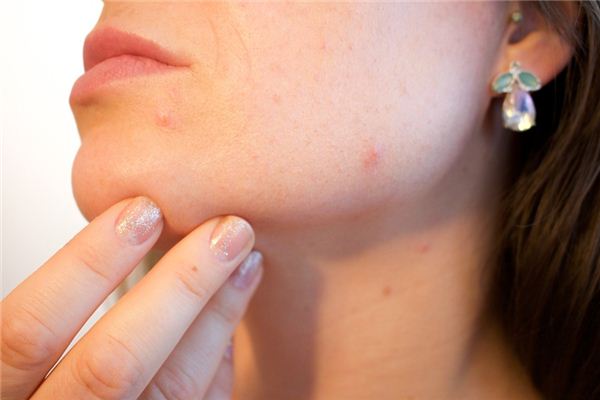 梦见丘疹是什么意思 梦见丘疹是什么意思